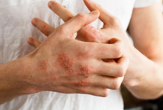 Rešite se Psorijaze Uz South Moon™ – Prirodna Krema za Brzo Olakšanje
