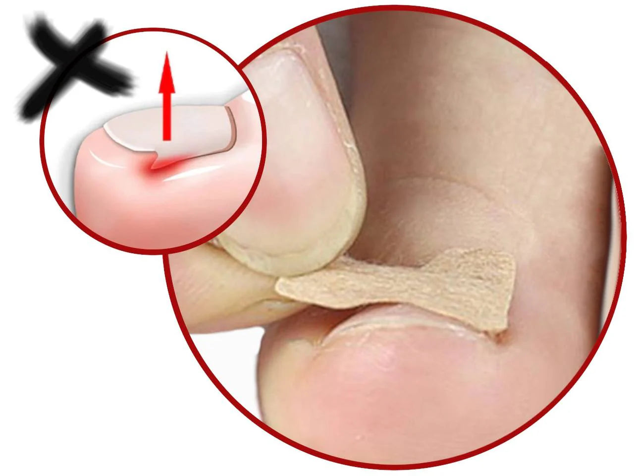 CRNI PETAK -Flasteri za urasle nokte - Idealni za svakodnevnu upotrebu